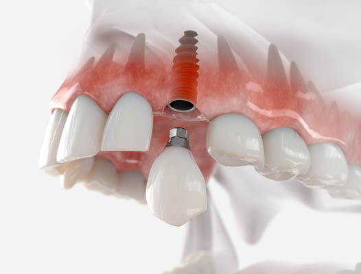 Dental Implant Houston, TX