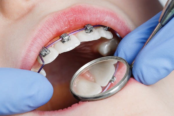 Receiving Traditional Braces From A General Dentist